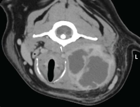 Transverse Plane Ct Images Of The Left Medial Retropharyngeal Lymph