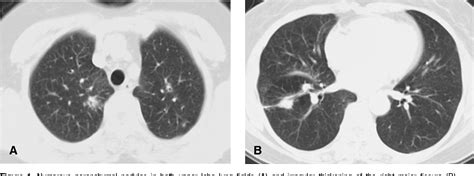 Figure 1 From Pulmonary Nodular Lymphoid Hyperplasia Associated With