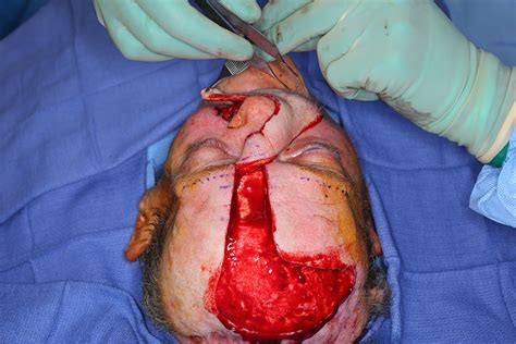 Extended Paramedian Forehead Flap For Total Upper Lip A Case Report