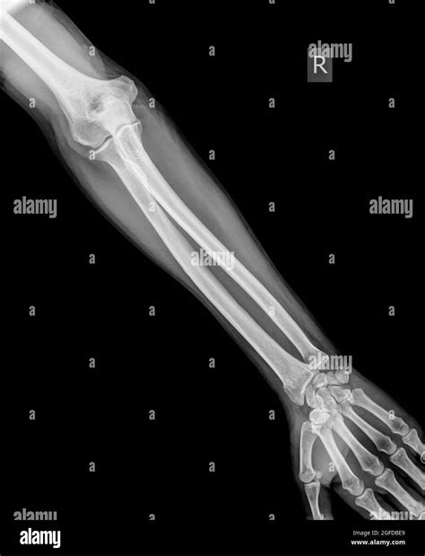 avant bras d un patient mâle de 64 ans présentant une fracture du rayon distal photo stock alamy