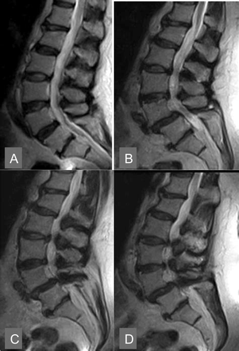 Lumbar Spinal Instability An Updated Rewiew Omics International