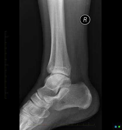 Achilles Tendinopathy Radiology Reference Article Radiopaedia Org