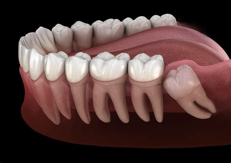 Wisdom Tooth Removal Complications Gavin Luis Maxillofacial Surgeon