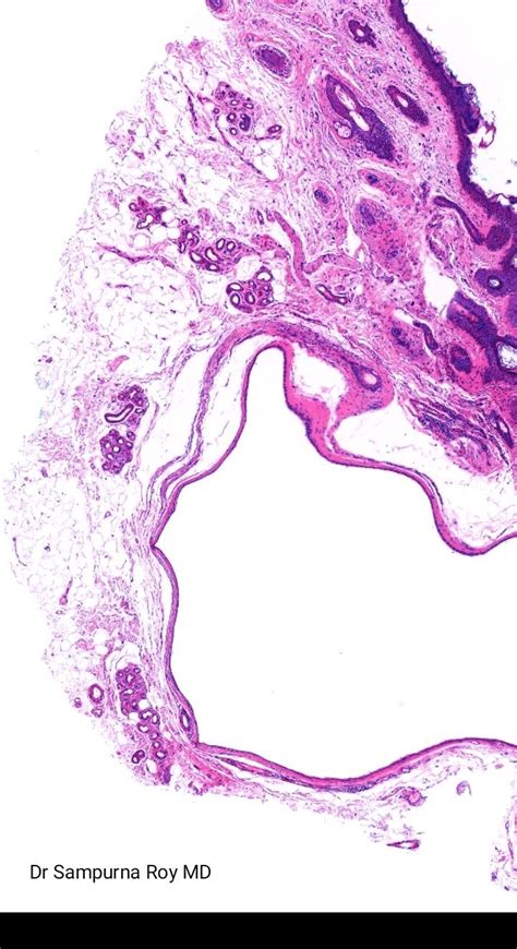 Pathology Of Eccrine Hidrocystoma In 2023 Microscopic Images