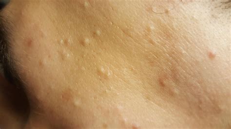 Skin Concern Forehead Bumps That Never Disappear Skincareaddiction