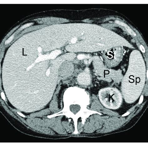 Example Of Normal Fused Abdominal Pet Ct Exam In Human Patient L