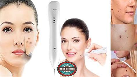 Laser Brown Spot Removal Laser Treatment To Remove Dark Spots On Face