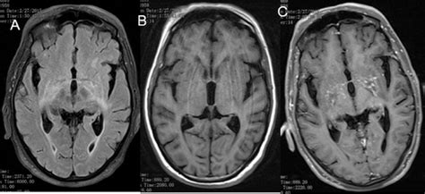E Cryptococcal Meningitis T2 Flair Image A Shows Hyperintensities In