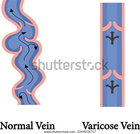 Varicose Veins Image Healthy Diseased Legs Stock Vector Royalty Free