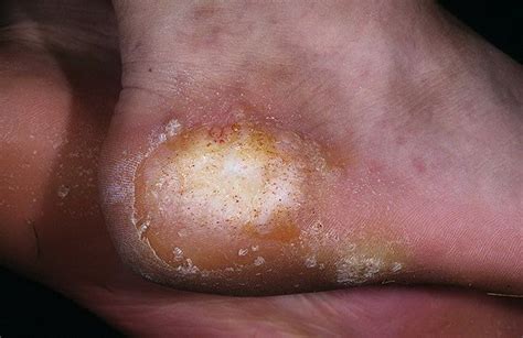 They're small, grainy bumps that are rough to the touch. Plantar Wart Pictures - 20 Photos & Images / illnessee.com
