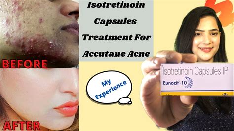 My Experience With Isotretinoin Isotretinoin Capsule For Acne Before After Benefits Side