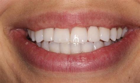 Invisalign And Veneers Before And After Photos North Miami Fl