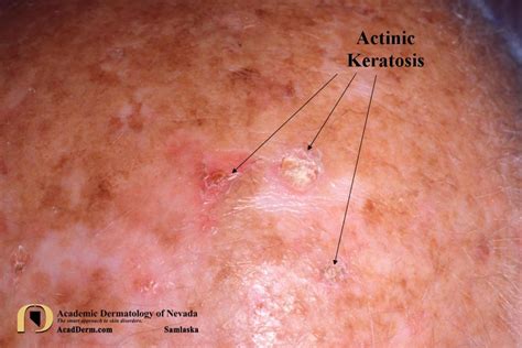 Actinic Keratosis What Is It Academic Dermatology Of