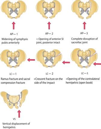 Pelvic Fractures Trauma Surgery GMKA Global Medical Knowledge Alliance