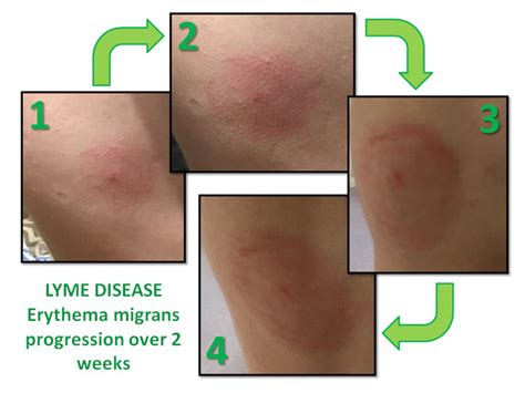 Lyme Disease Rash Progression On Landscape