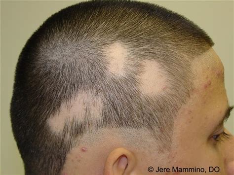 Alopecia Areata American Osteopathic College Of Dermatology Aocd