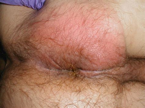 Perirectal Abscess Article Hot Sex Picture
