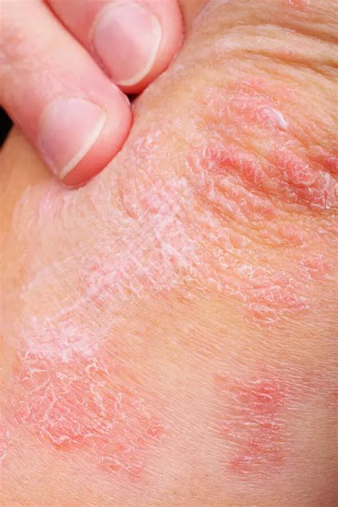 Kinds Of Skin Diseases Answering All Kinds Of Questions