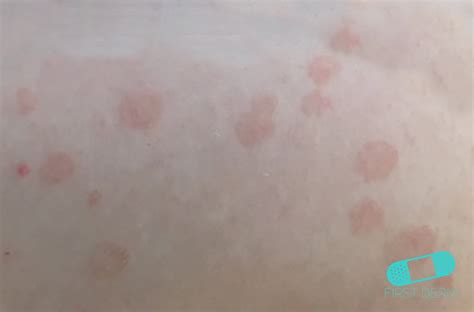 Pityriasis rosea is associated with reactivation of herpesviruses 6 and 7, which cause the primary rash roseola in infants. Online Dermatology - Pityriasis Rosea