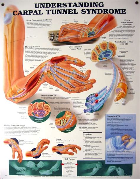 Carpal Tunnel Syndrome Carpal Tunnel Massage Therapy