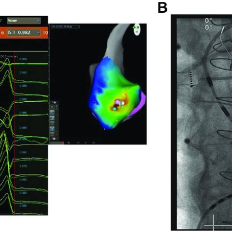 A Activation Mapping Of The Left Ventricular Outflow Tract Lvot