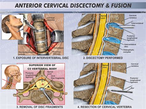 Anterior Cervical Discectomy Fusion Female Order