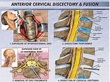 Cervical Discectomy Recovery