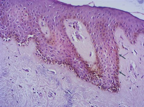 Acanthosis And Hyperpigmentation Of Basal Cells Especially At The Rete