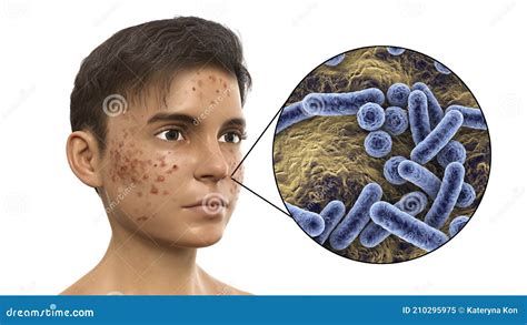 Acne Pimples And Closeup View Of Bacteria The Causative Agents Of Skin