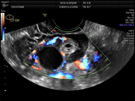 Sonographic Detection Of Ovarian Ectopic Pregnancy A Case Study
