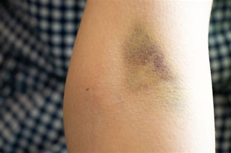 What Is Bruising Easily A Sign Of Medforthospitals