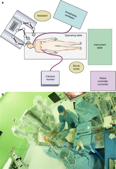 Robotic Thyroidectomy Bilateral Axillo Breast Approach BABA