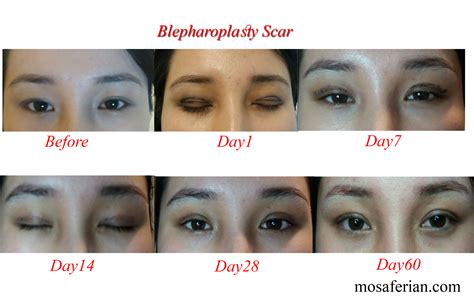 Upper Eyelid Surgery Recovery Cheaper Than Retail Price Buy Clothing