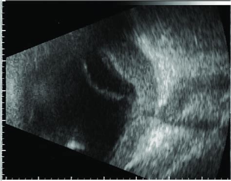 B Scan Ultrasound Of The Left Eye On The First Visit Of The Patient To