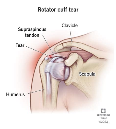 Rotator Cuff Tear Symptoms Treatment The Best Porn Website