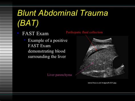 Sonographic Assessment Of Blunt Abdominal Trauma In The Emergency Dep