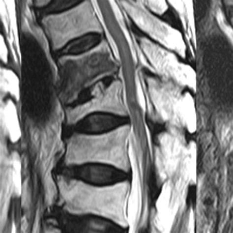 Mri On 1st Admission Recent Benign Compression Fracture Of T10 Body