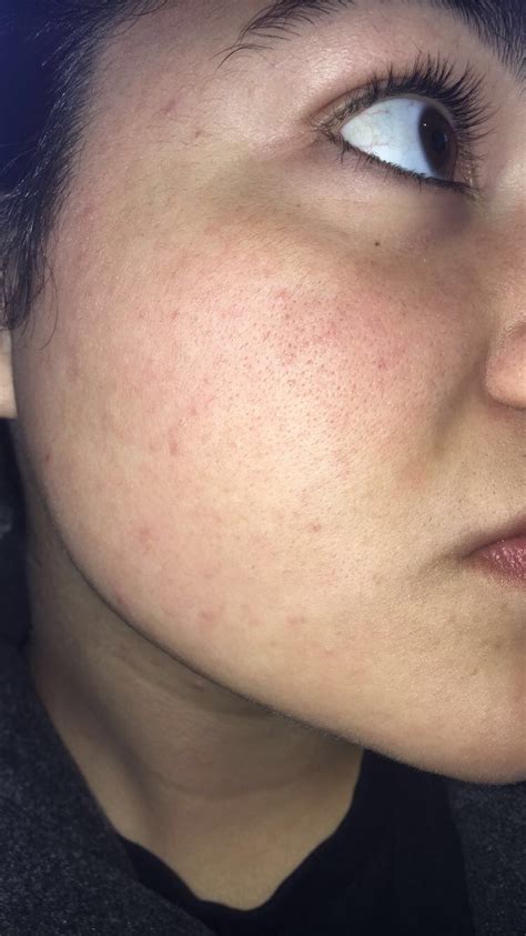 Closed Comedowns Clogged Pores General Acne Discussion