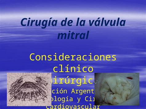 Ppt Cirugía De La Válvula Mitral Consideraciones Clínico Quirúrgicas