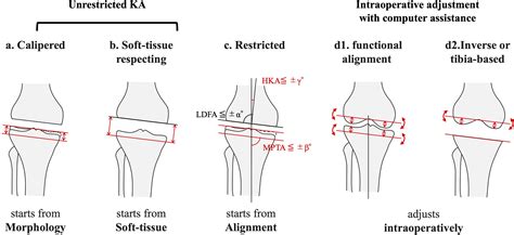 Current Concept Of Kinematic Alignment Total Knee Arthroplasty And Its