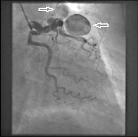 Surgical Repair Of A Coronary Artery Aneurysm Associated With Coronary