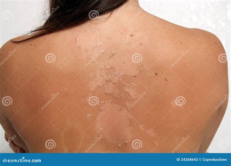 Sunburned Peeling Female 3 Stock Image Image Of Dermatological