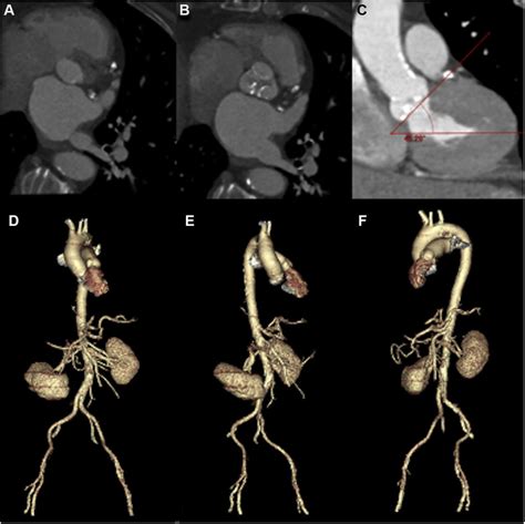 Computed Tomography Transcatheter Aortic Valve Replacement