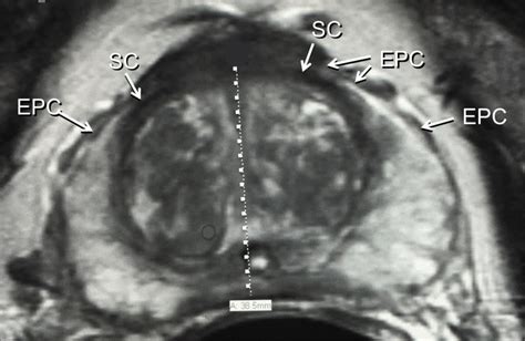 C Axial T2 Weighted Mri Right And Left External Prostatic Capsule