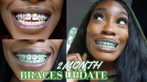 2 Month Braces Update Youtube