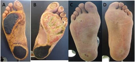 Stages Of Diabetic Foot Ulcer
