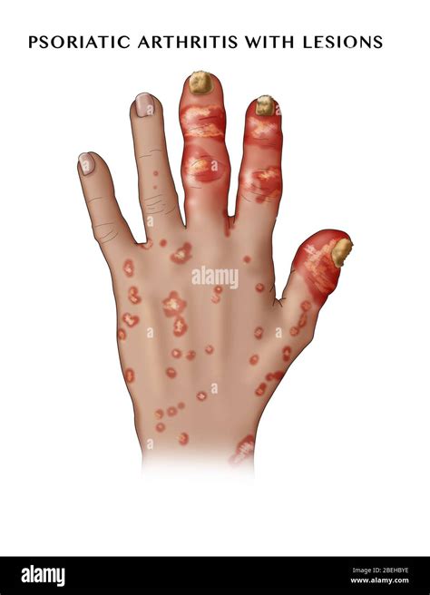 Psoriatic Arthritis Nails Hi Res Stock Photography And Images Alamy