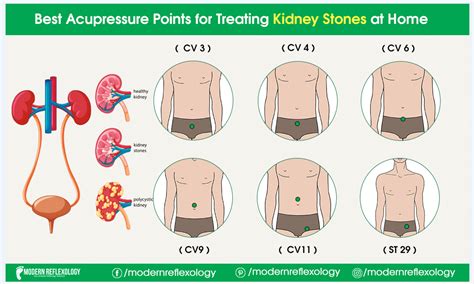 Kidney Stone Pain Symptoms