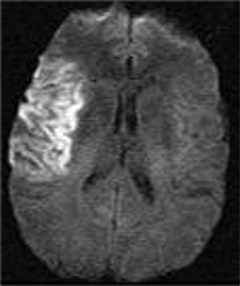 The Patient With Transient Cerebral Ischemia A Golden Opportunity For