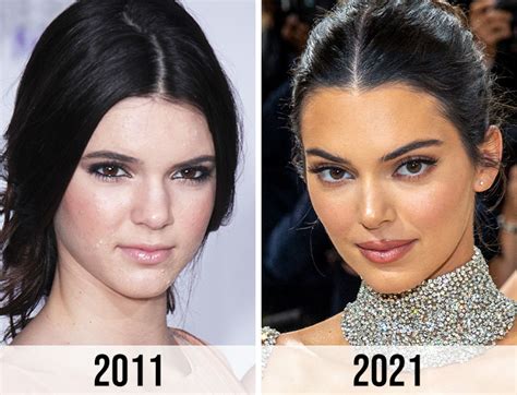 Kendall Jenner Before Plastic Surgery